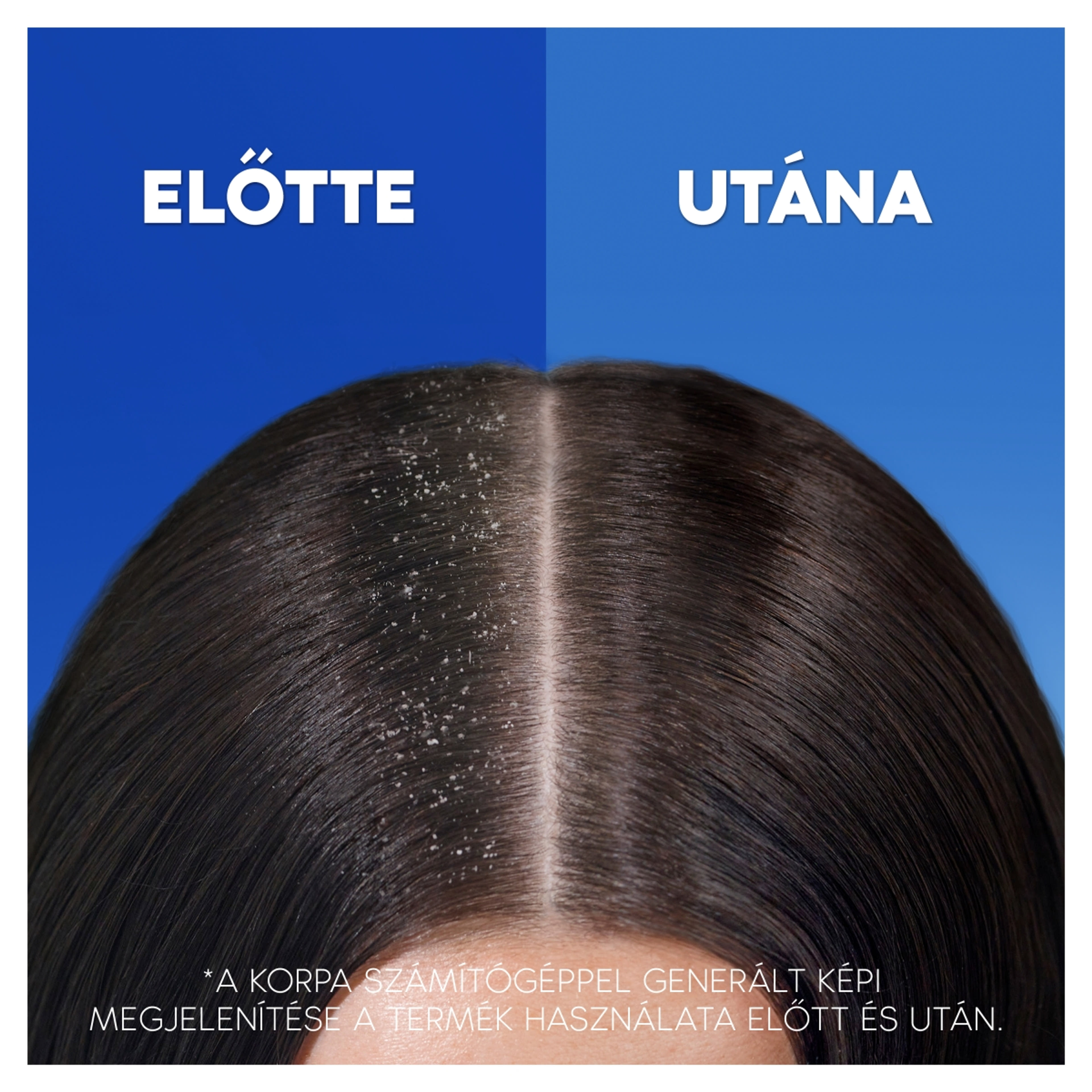 Head & Shoulders Érsékeny Fejbőrre Korpásodás Elleni sampon - 400 ml-4